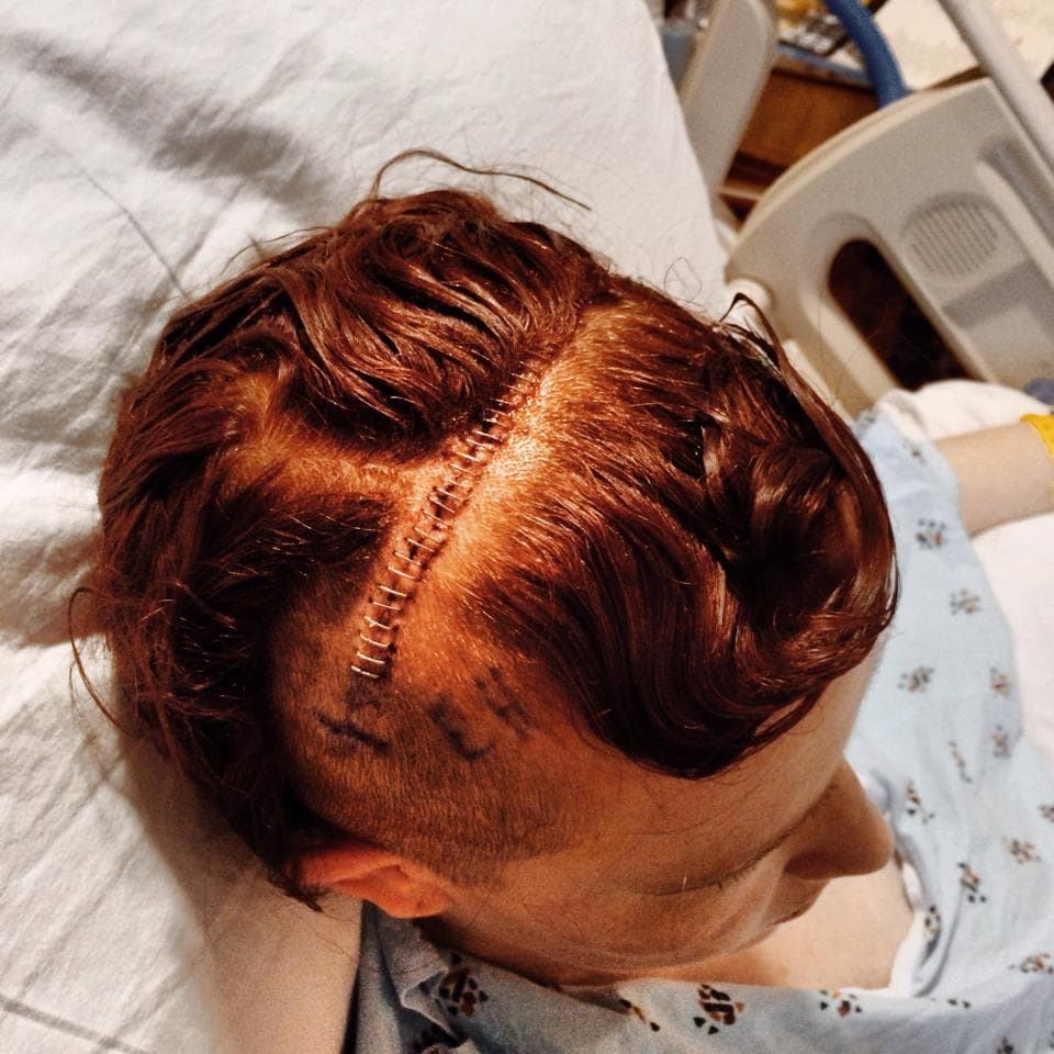 This is my "head zipper" after they took the bandages off. 